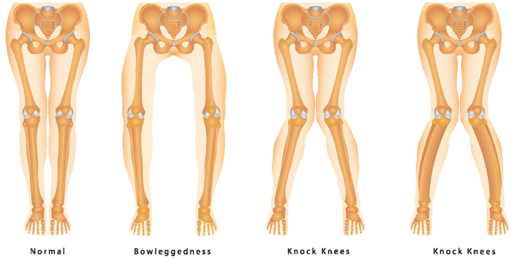 Knee Angular Deformities (Knock legs and Bow legs) | Orthopaedic ...